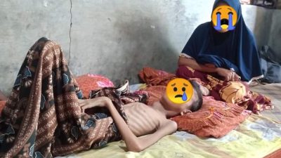 Mengkhawatirkan, Anak-Anak Aceh Utara Terbungkus Tulang, Penggiat Sosial: Pemerintah Harus Serius